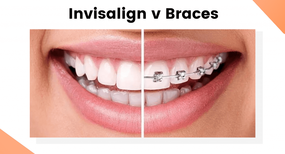 Best Invisalign treatment in Velachery, Chennai at Luxe Dental - Personalized and discreet teeth straightening for a confident smile